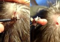 Eksotisks suvenīrs: no galvas izlien milzīgs kāpurs- mēnesi pēc inficēšanās! FOTO/,VIDEO