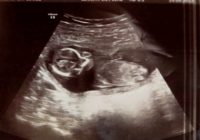Šī sieviete piedzīvoja spontāno abortu. Taču 10 dienas vēlāk ārsti sadzirdēja bērna sirdspukstus! FOTO