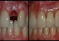 Izaudzēt jaunus zobus 9 nedēļās: procedūra, kas iespējama jebkurā vecumā!