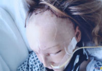 Meitenei noņēma seju, lai atjaunotu avārijā sadragātos galvaskausa kaulus un lūk kā viņa izskatās tagad! FOTO