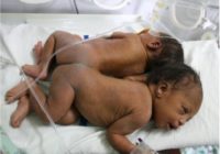 Mazuļi piedzima ar savienotiem mugurkauliem, taču ārsti uzdrīkstējās viņus atdalīt! FOTO