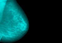 4 krūts vēža simptomi, kam nav nekāda sakara ar sabiezējumiem