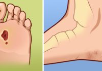 Kas ir diabētiskās pēdas sindroms un kā ar to cīnīties?