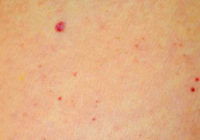 Sarkani punktiņi uz ādas- slimība vai kosmētisks defekts?