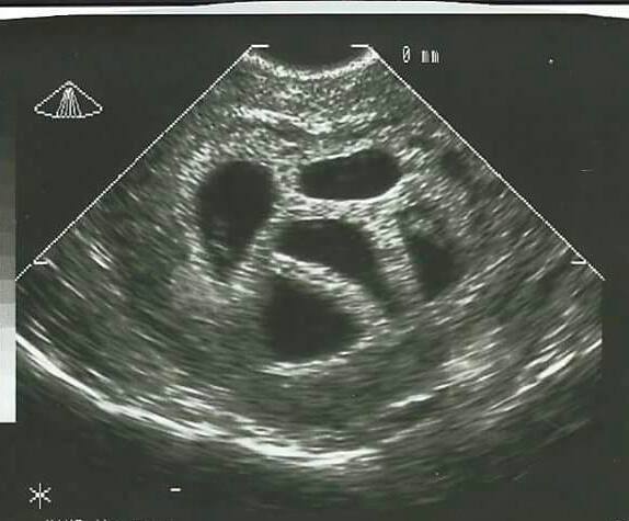 Ārsti piecu bērnu māmiņu centās pārliecināt veikt abortu. Paskatieties uz viņiem 18 gadus vēlāk! FOTO