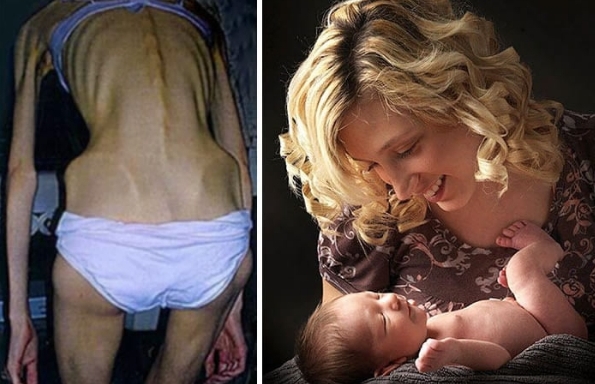 Pirms un pēc: 15 fotogrāfijas ar cilvēkiem, kuri uzveikuši anoreksiju. FOTO