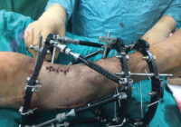 Lai palīdzētu satiksmes negadījumā cietušam vīrietim, Austrumu slimnīcā veikta pirmā Baltijā operācija ar ortopēdisko heksapodu
