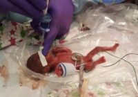 FOTO, VIDEO: Ārsti domāja, ka mazulīte nodzīvos stundu. Bet viņa pārsteidz visu pasauli!